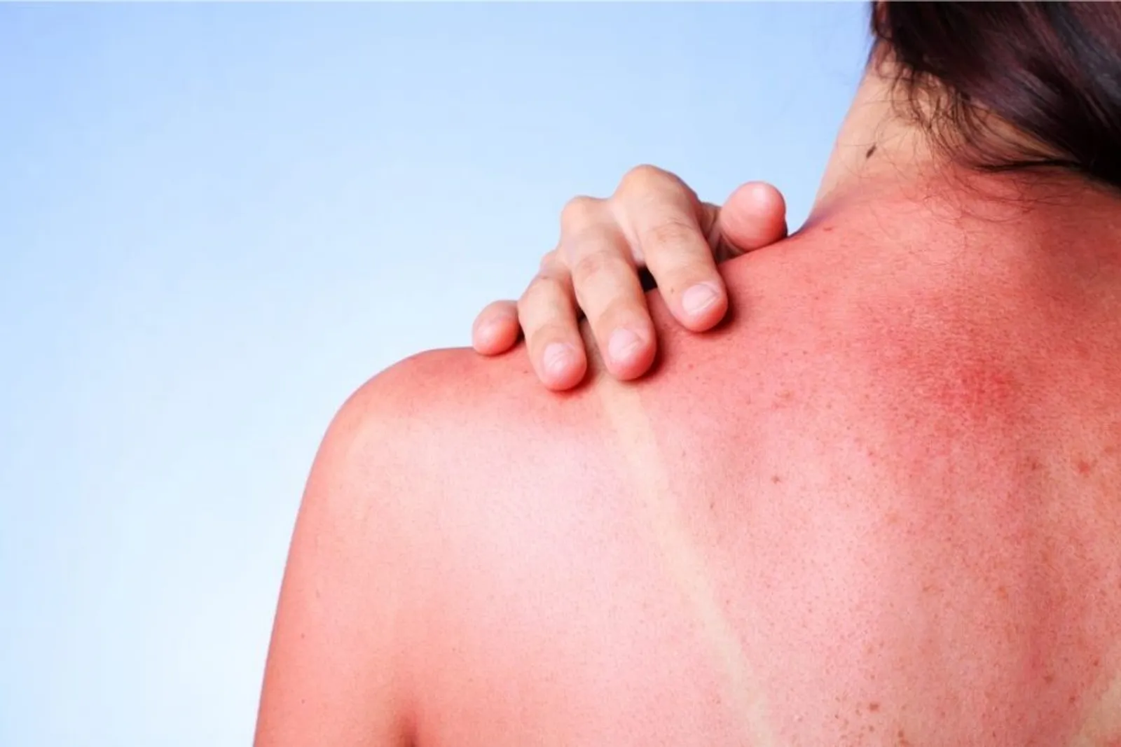 5 Cara Ampuh Mengatasi Sunburn