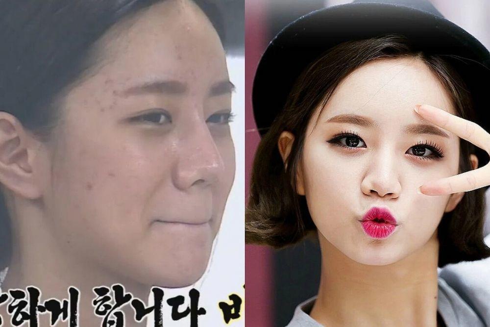Punya Wajah Mulus, 9 Artis Korea Ini Pernah Berjuang Melawan Jerawat