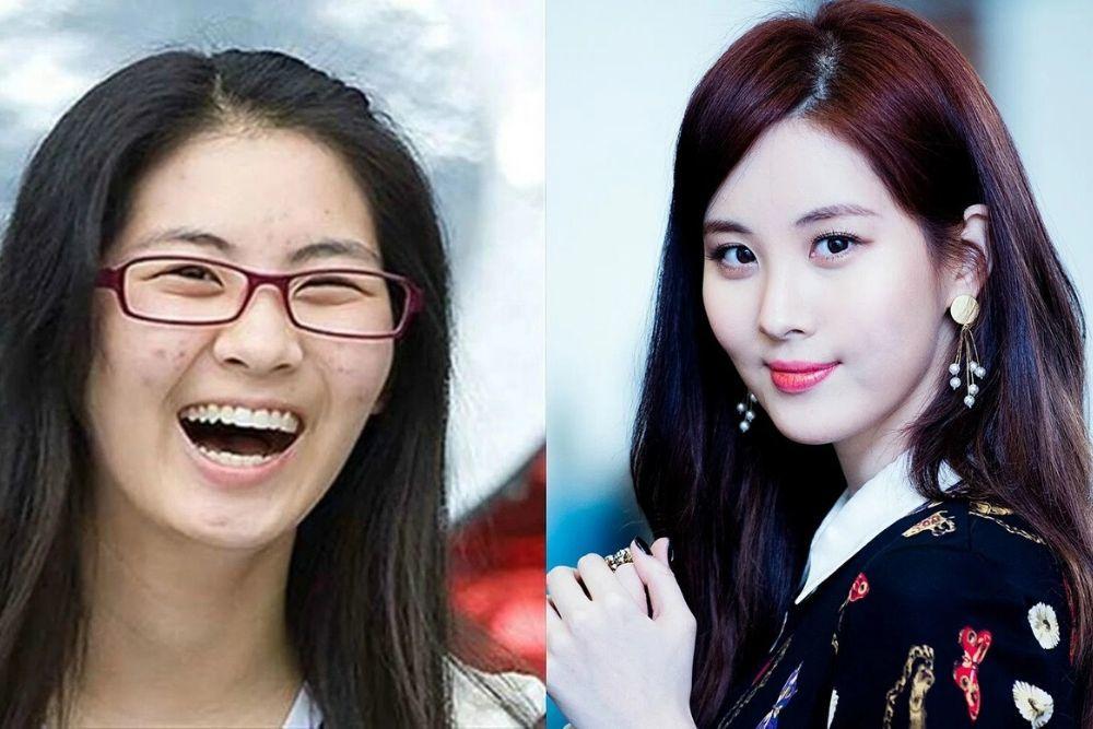 Punya Wajah Mulus, 9 Artis Korea Ini Pernah Berjuang Melawan Jerawat
