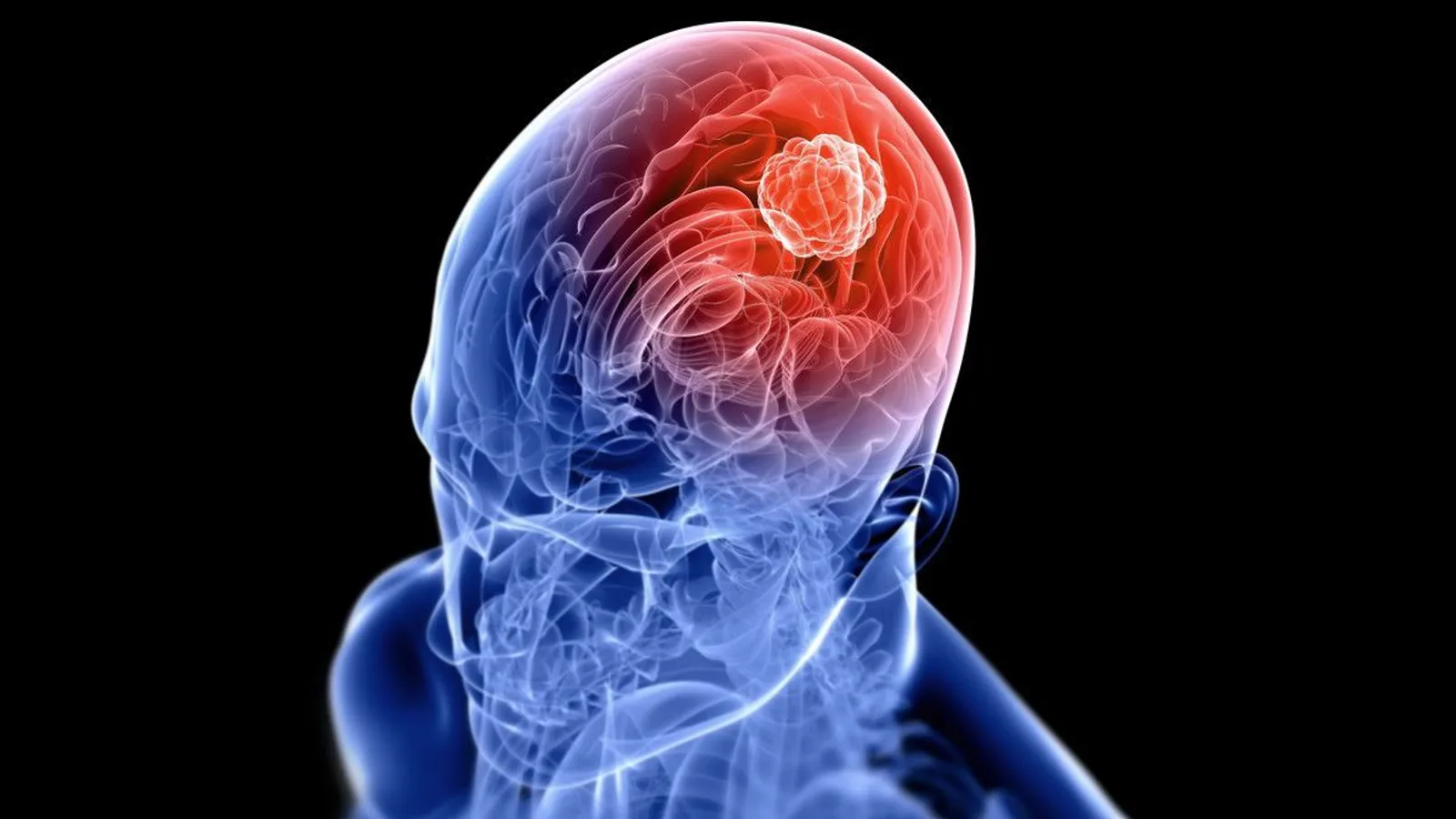 5 Macam Sakit Kepala yang Tak Kunjung Berhenti Ini Harus Kamu Waspadai