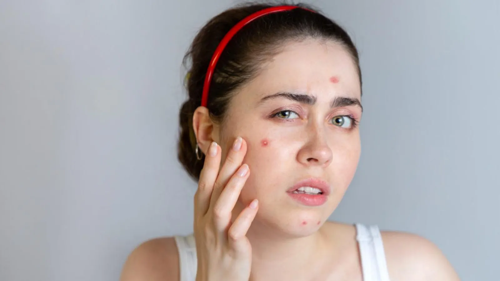 Alami Fungal Acne? Ini 5 Kandungan Skincare yang Harus Dihindari 