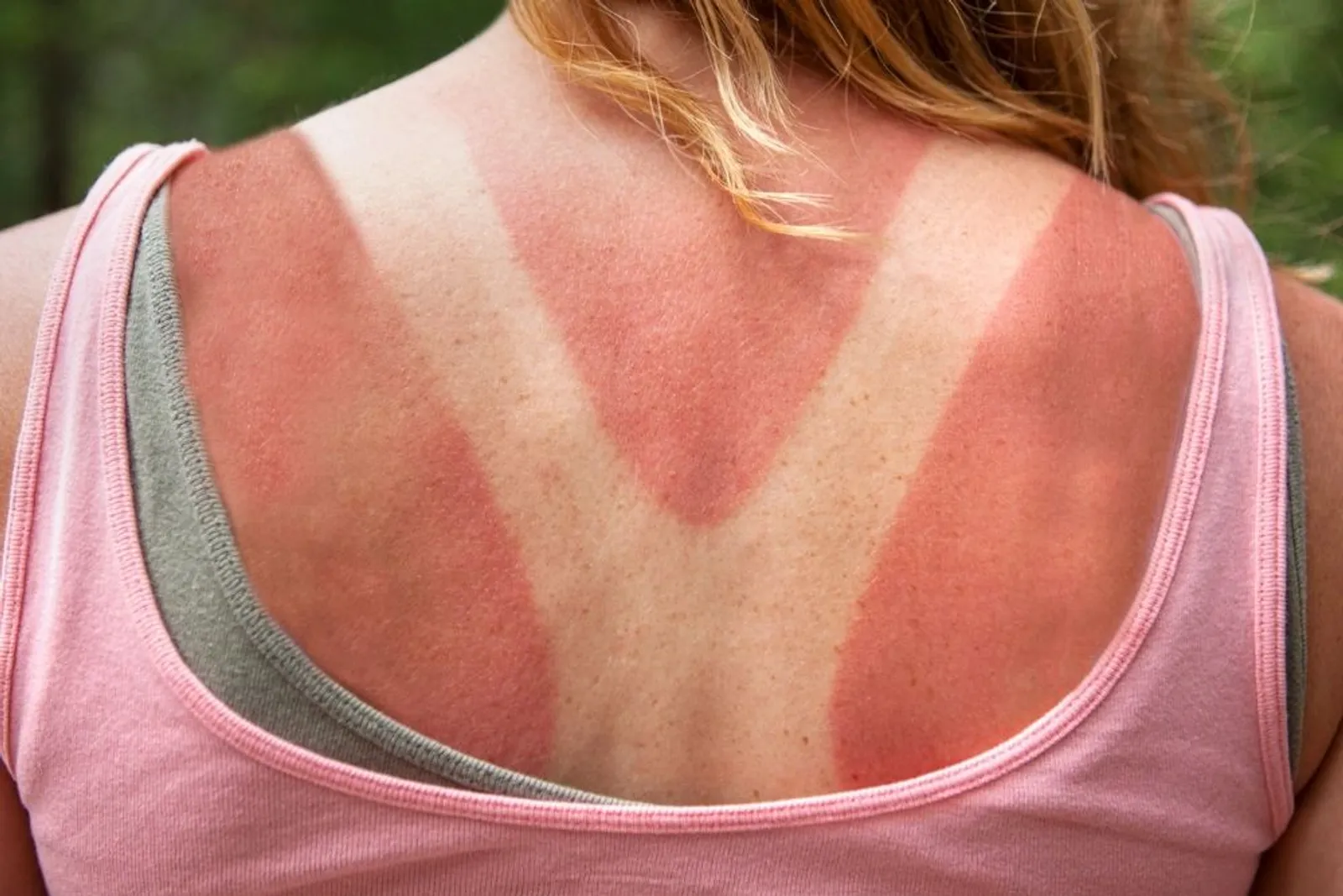 7 Alasan Mengapa Sunscreen Wajib Digunakan Setiap Hari