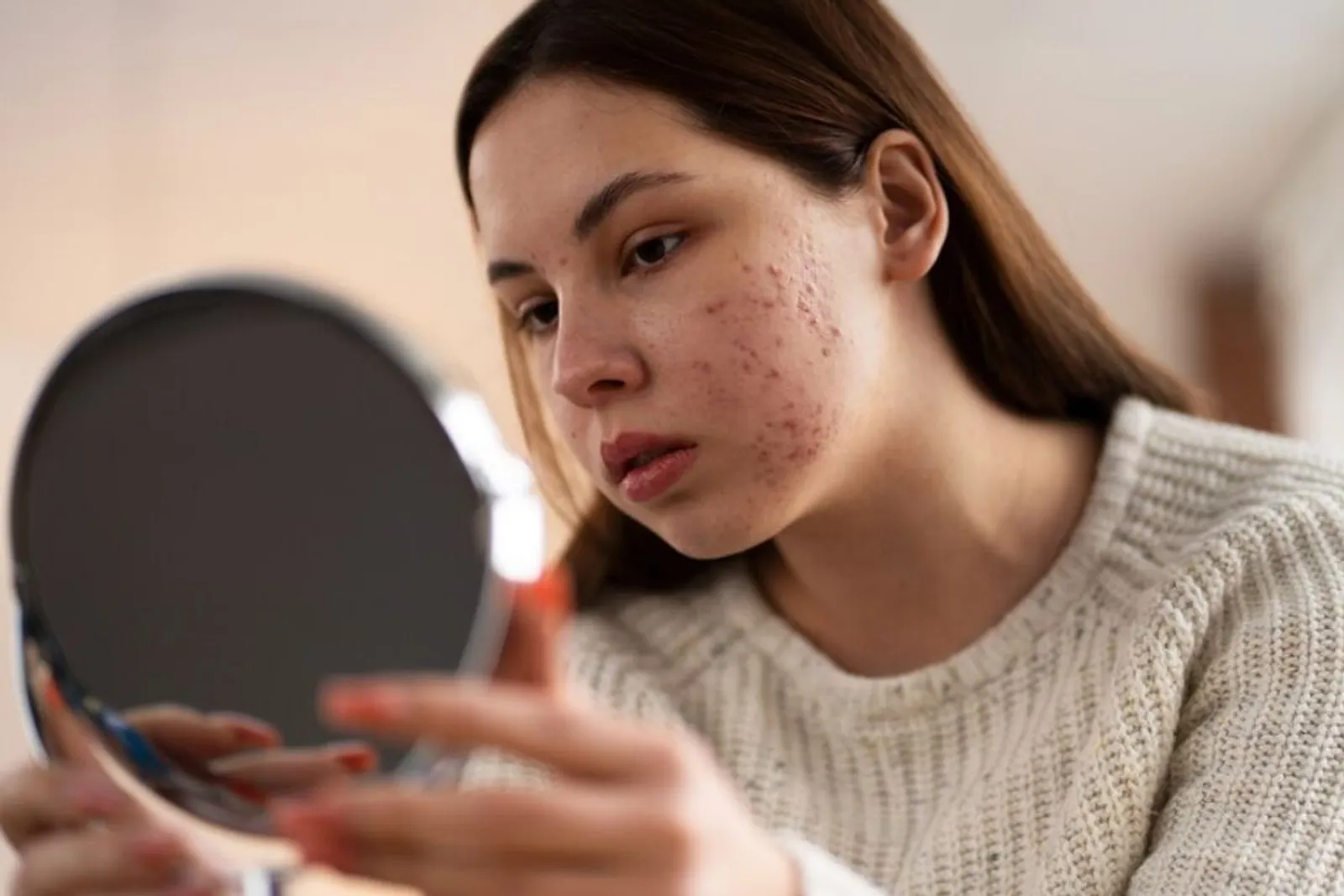 Efek Samping Penggunaan Acne Patch yang Perlu Kamu Ketahui 