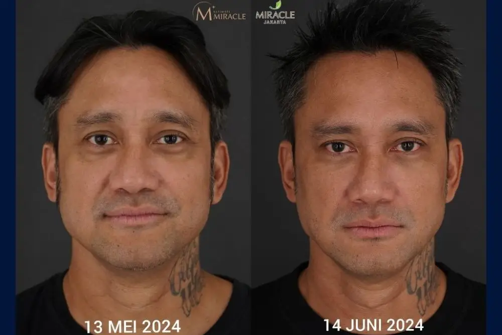 Ini Teknik untuk Facial Reshaping Tanpa Kehilangan Karakter Wajah 