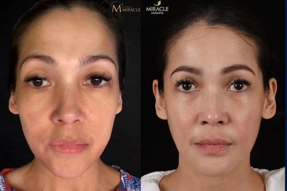 Ini Teknik untuk Facial Reshaping Tanpa Kehilangan Karakter Wajah 