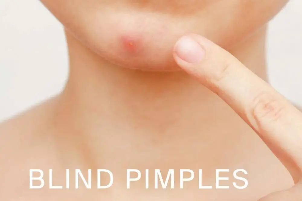 Menganal Blind Pimple: Penyebab Hingga Cara Mengatasi