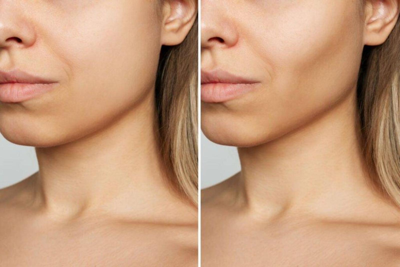Efek Samping Buccal Fat Removal, Ini yang Perlu Kamu Ketahui! 