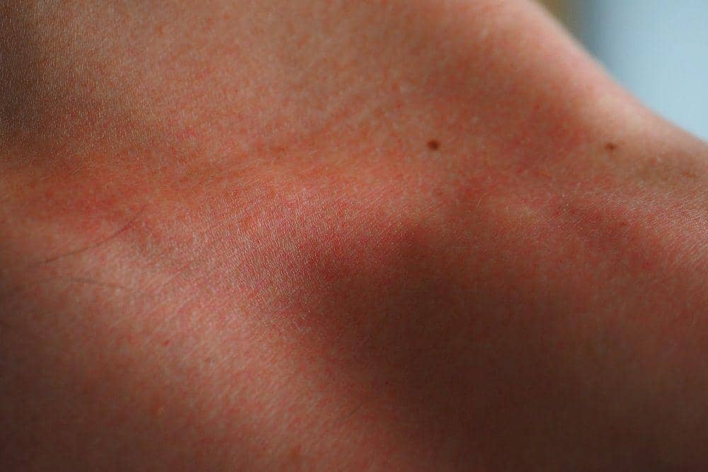 ilustrasi kulit gosong akibat cuaca panas (pixabay.com/hans-2)