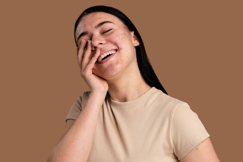 Urutan Skincare untuk Kulit Berjerawat, dari Pagi hingga Malam Hari
