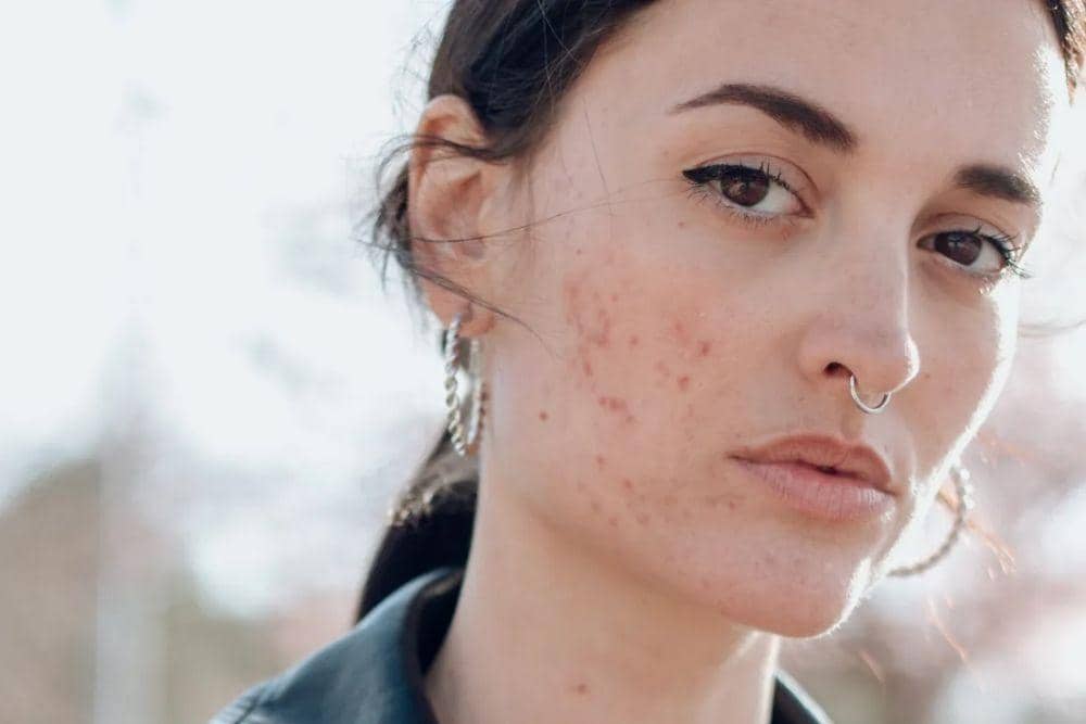 Begini Cara Menyamarkan Jerawat dengan Makeup