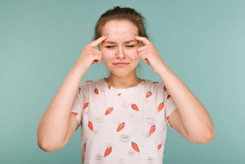 Bahaya Sering Memencet Jerawat, freepik.com