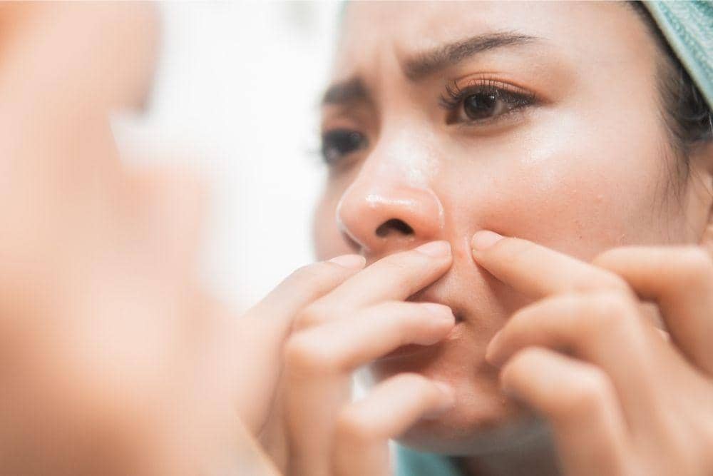 Bahaya Sering Memencet Jerawat, freepik.com