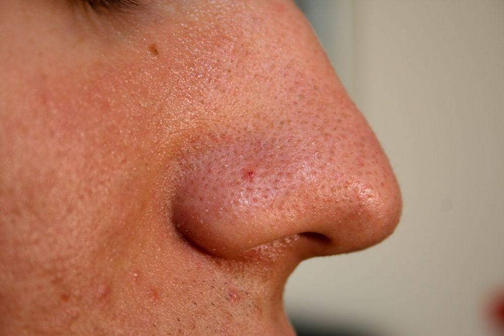 Penyebab Komedo di Hidung dan Cara Menghilangkannya