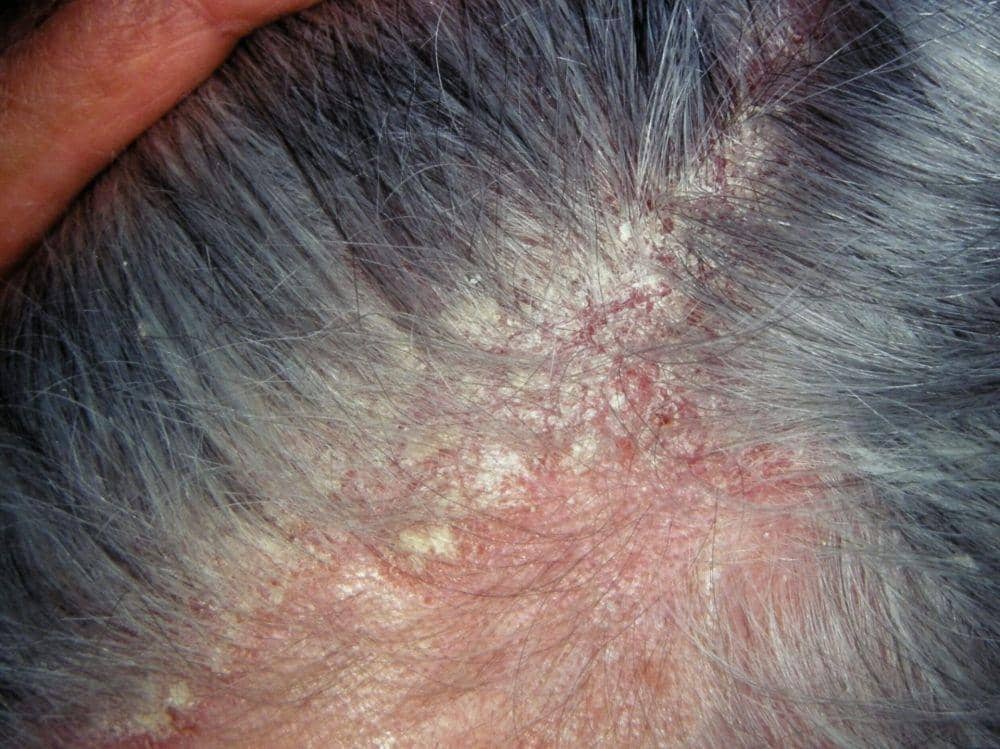 dermatitis atopik
