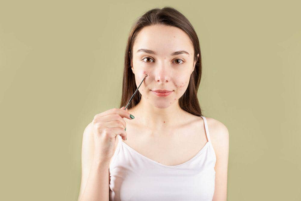 ilustrasi perempuan pemilik acne prone skin