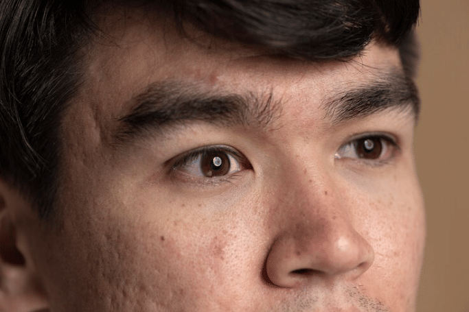 ilustrasi bekas jerawat bopeng