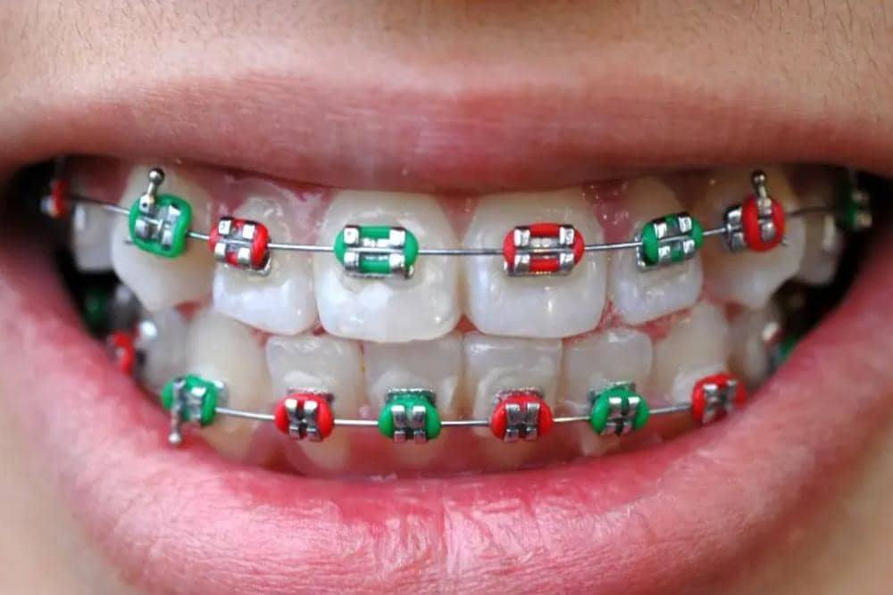 diamondbraces.com
