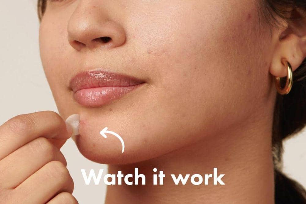 ubuy.co.id/Cara Pakai Acne Patch