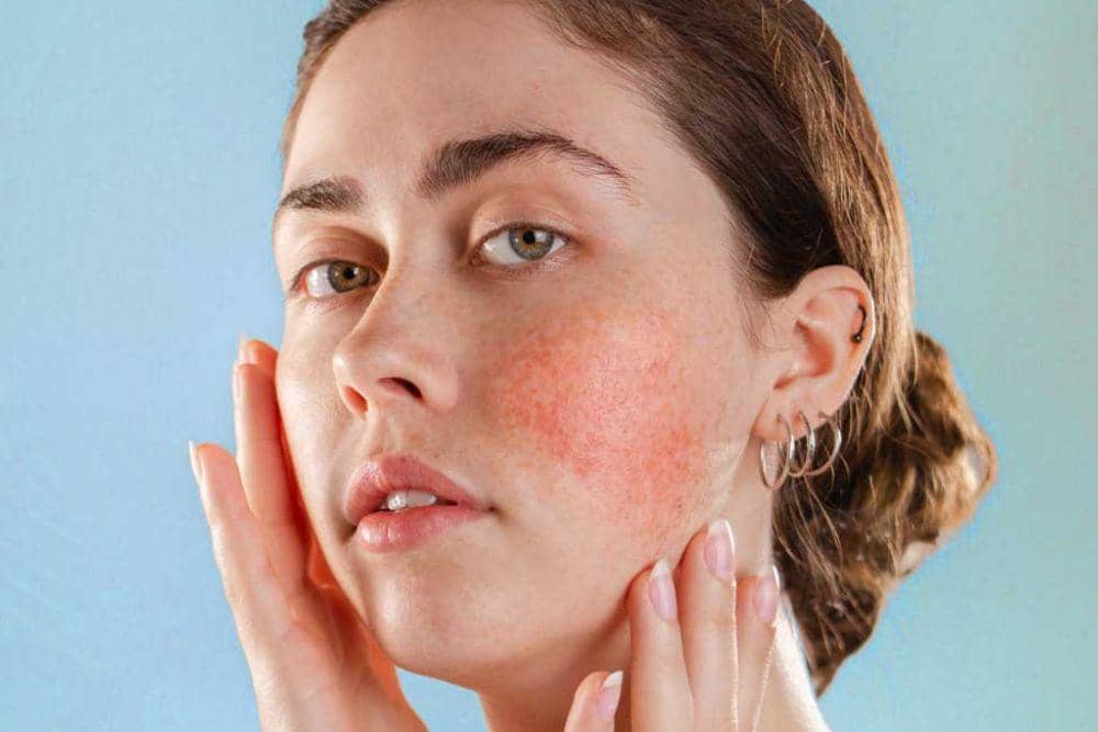 adaptology.com/Ciri Jerawat Karena Tidak Cocok Skincare