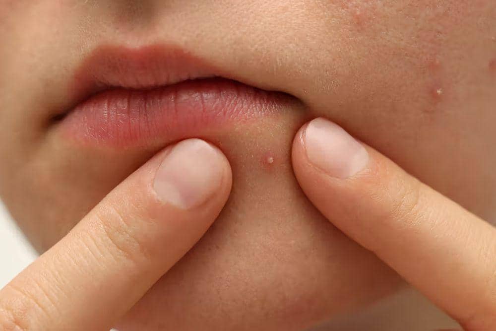 healthline.com/Ciri Jerawat Karena Tidak Cocok Skincare