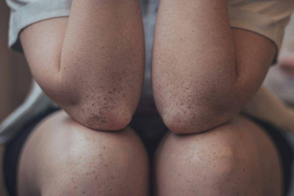 Ilustrasi siku dan lutut (unsplash.com/Lucaxx Freire)