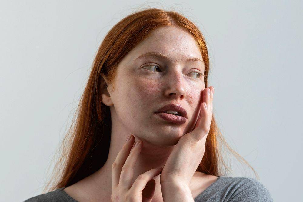 Penyebab dan cara mengatasi jerawat batu di hidung