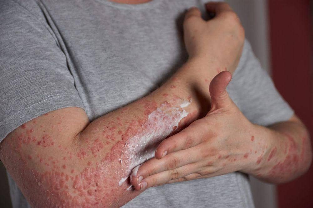 Ilsutrasi Psoriasis 