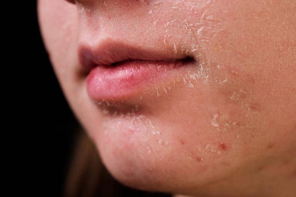 ilustrasi kulit kering (pexels.com/sora)