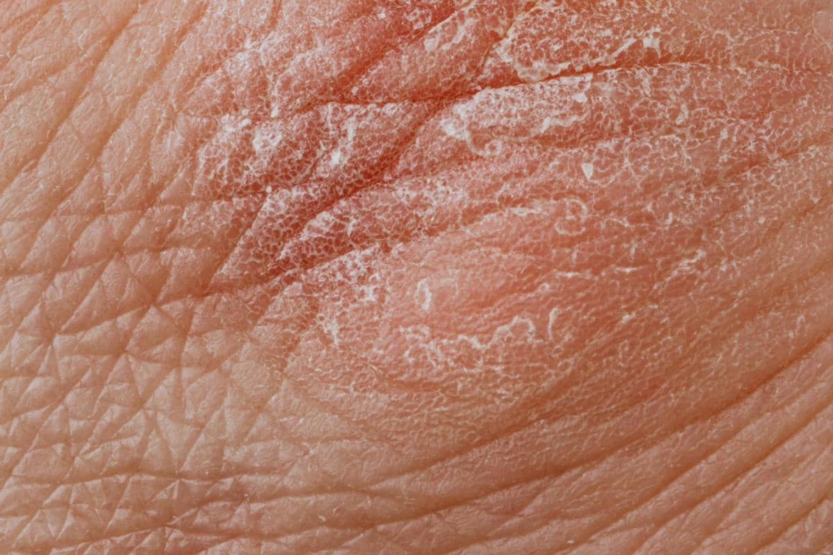 ilustrasi kulit kering atau dry skin