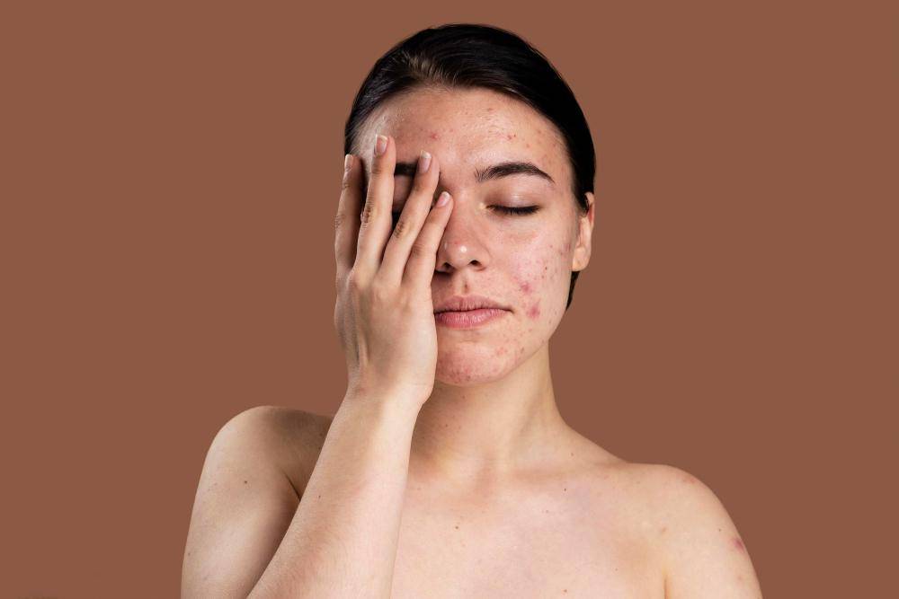 melasma