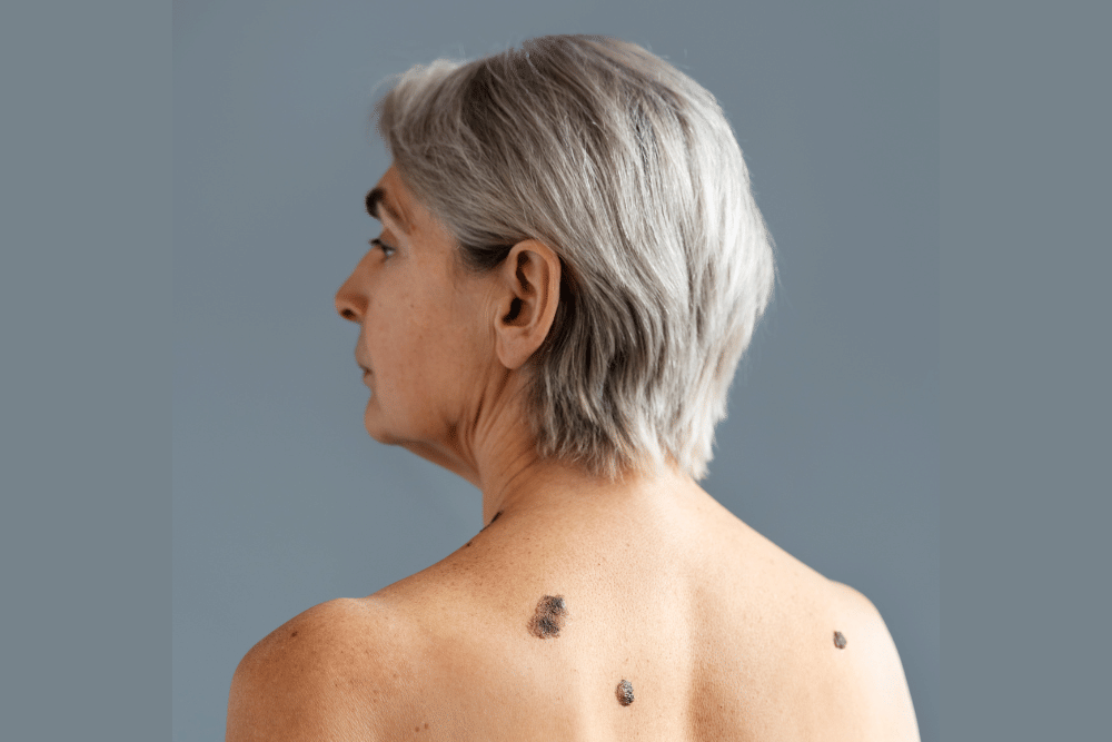 tahi lalat di punggung perempuan