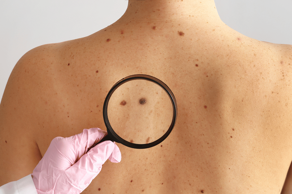 tahi lalat di punggung perempuan