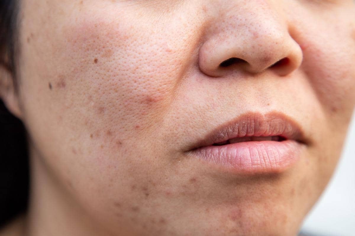 Penyebab Komedo di Dagu dan Cara Mengatasinya