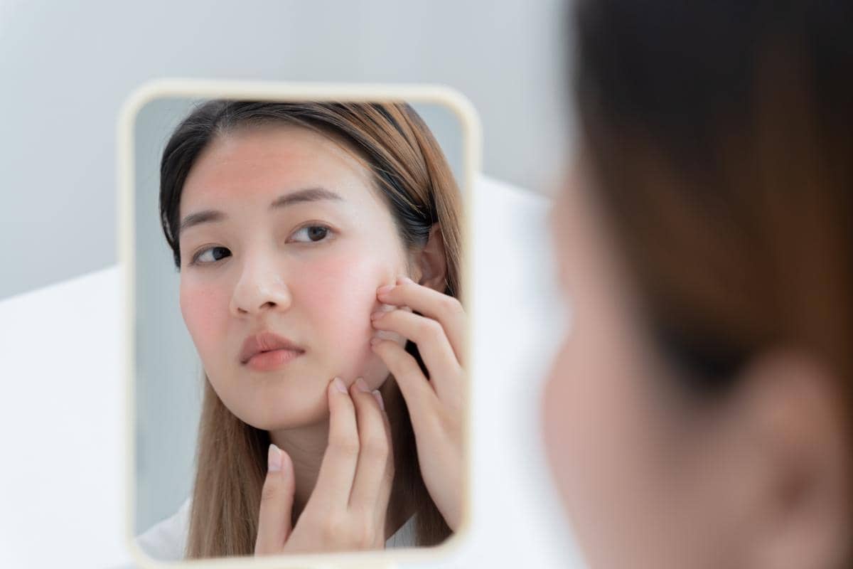 Perawatan Wajah Berjerawat yang Efektif