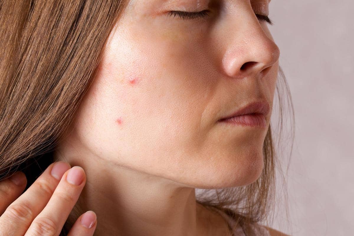 Ilustrasi wajah berjerawat 