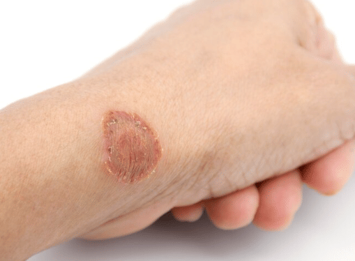 ilustrasi jamur kulit 