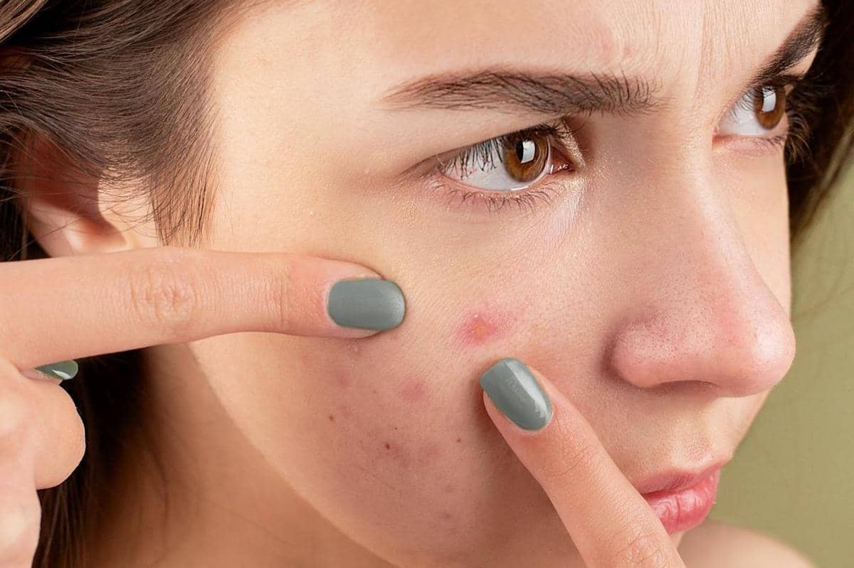 Ilustrasi jerawat di wajah