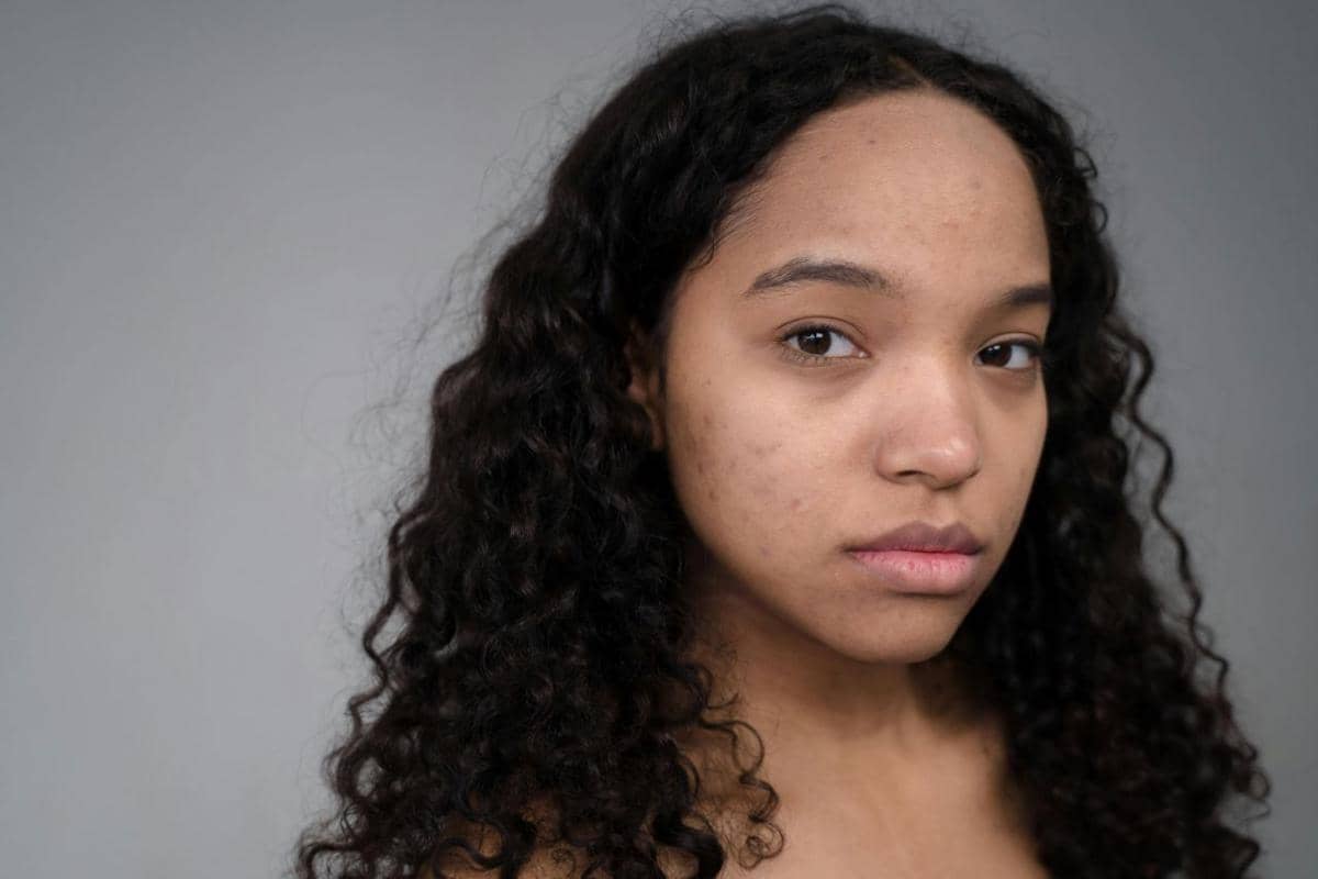 manfaat retinol untuk jerawat