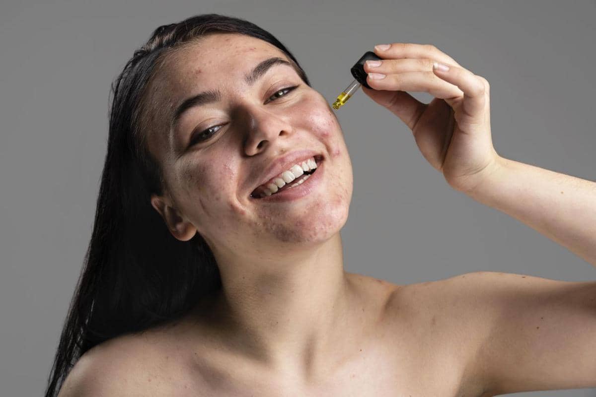 apakah retinol bisa menghilangkan jerawat