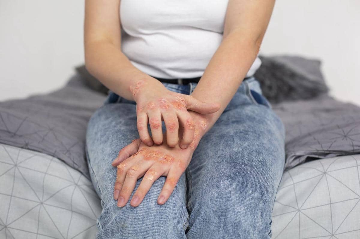 7 Cara Mengatasi Eksim Kulit Kering dan Gatal yang Aman