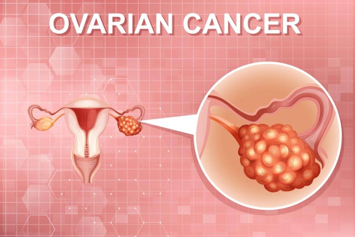 7 Penyebab Kanker Ovarium yang Perlu Diwaspadai, Apa Saja? 
