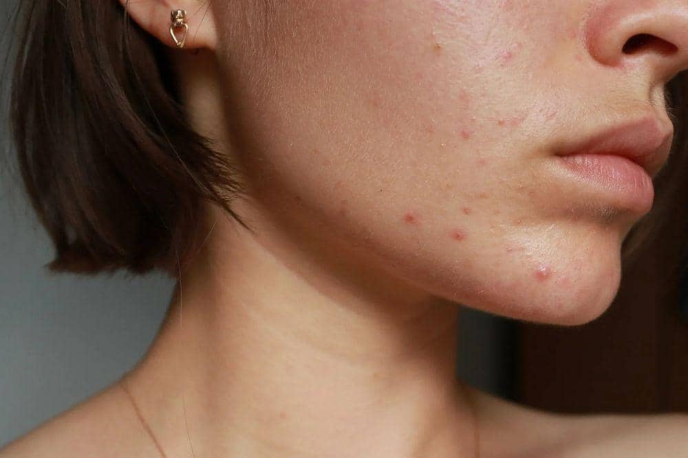 Cara Menghilangkan Jerawat Hormonal: 5 Langkah Efektif Kulit Sehat