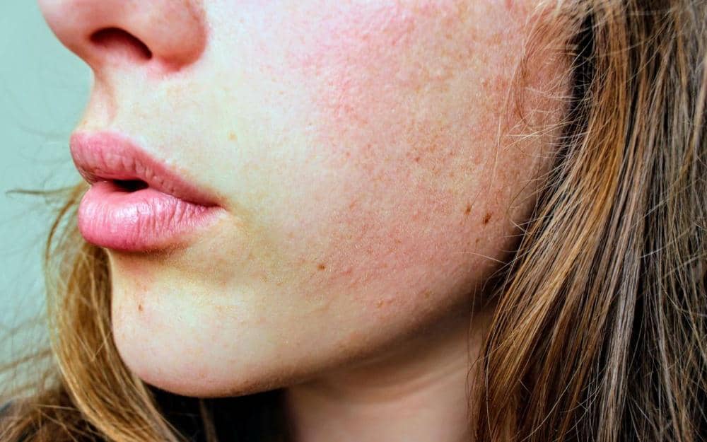 Kenapa wajah bruntusan padahal skincare sama?