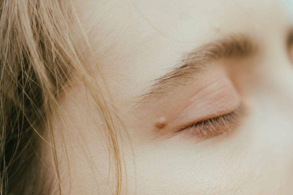 Cara mengatasi skin tag