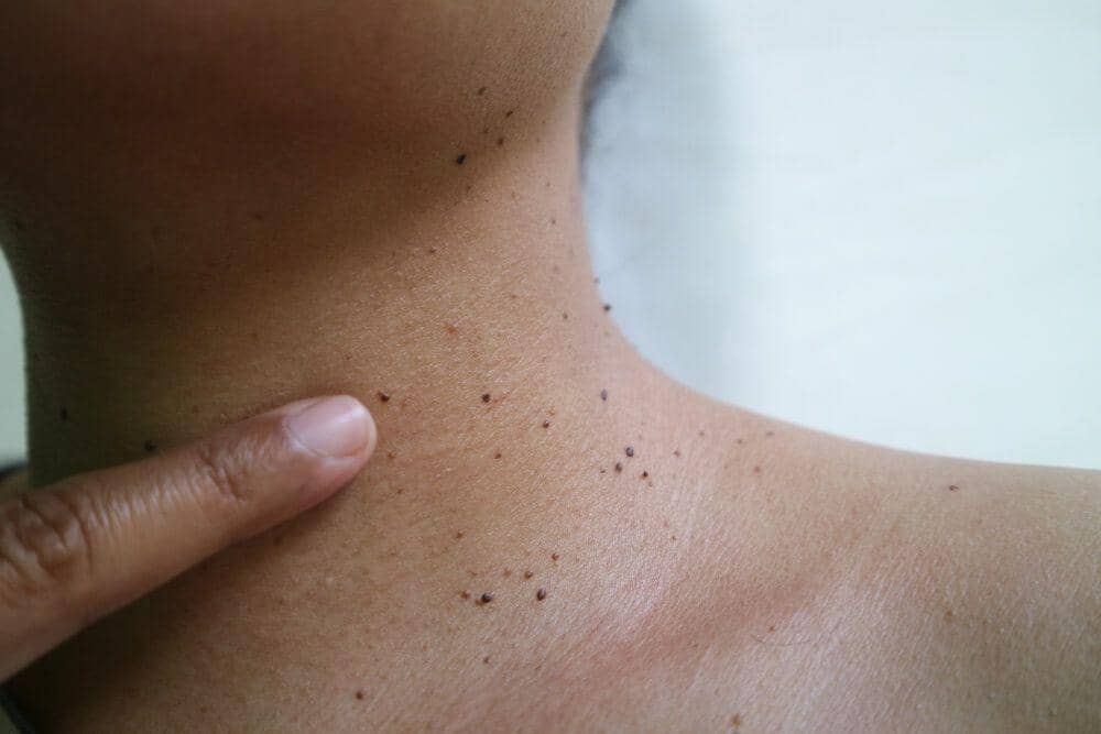 Cara mengatasi skin tag