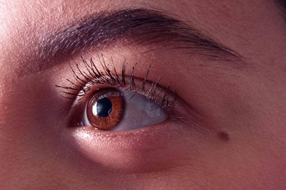 Cara mengatasi skin tag
