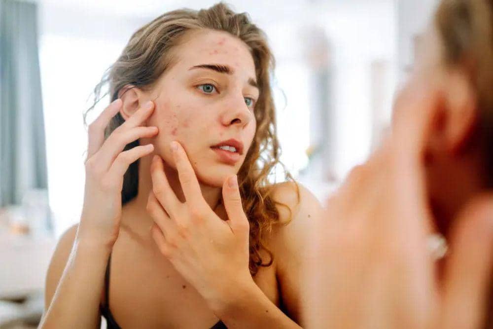 Stres hingga Periode Menstruasi, 6 Penyebab Munculnya Jerawat Hormonal