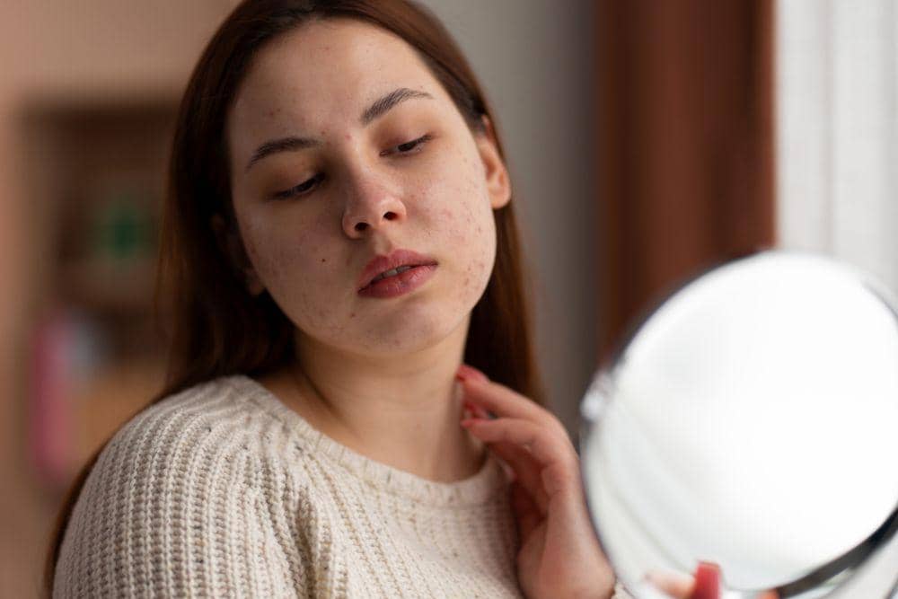 Penyebab Munculnya Jerawat Hormonal