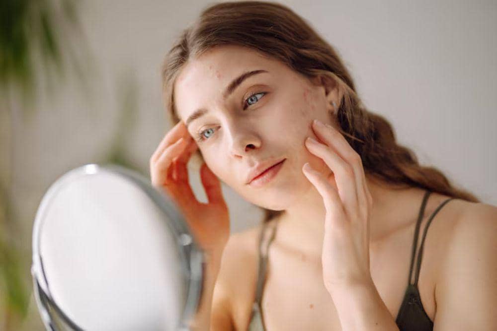 Penyebab Munculnya Jerawat Hormonal