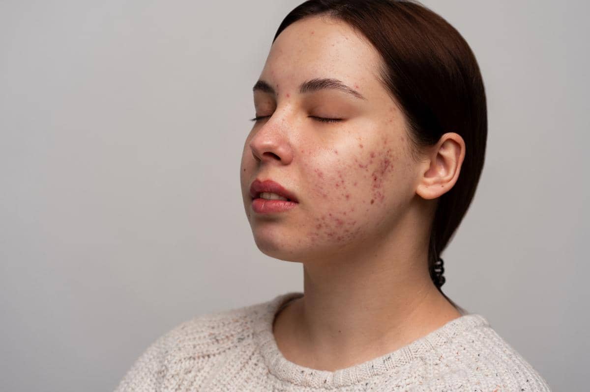 5 Cara Mengatasi Kulit Over Eksfoliasi, Bantu Pulihkan Skin Barrier